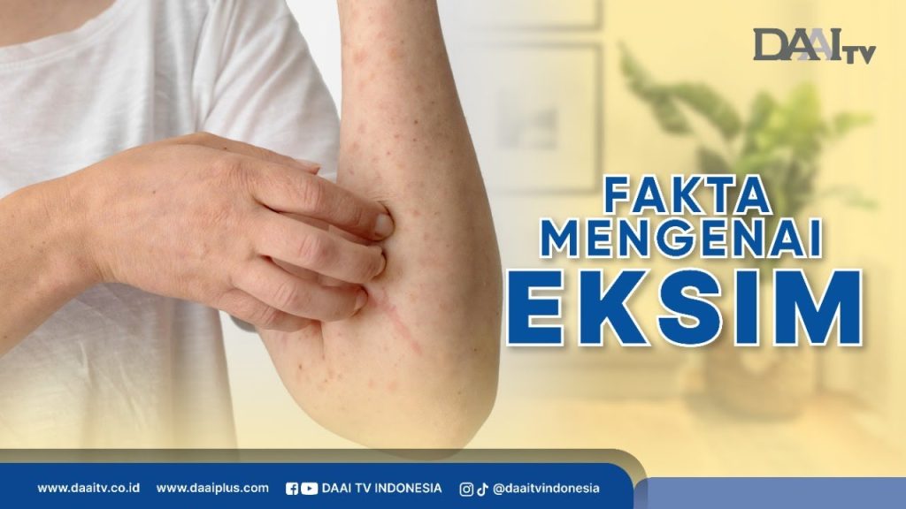 Fakta Medis Seputar Eksim Memahami Kondisi Kulit Yang Mengganggu