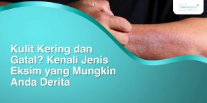 Kesalahan Umum Saat Menghadapi Eksim Panduan Komprehensif Untuk Perawatan Yang Efektif
